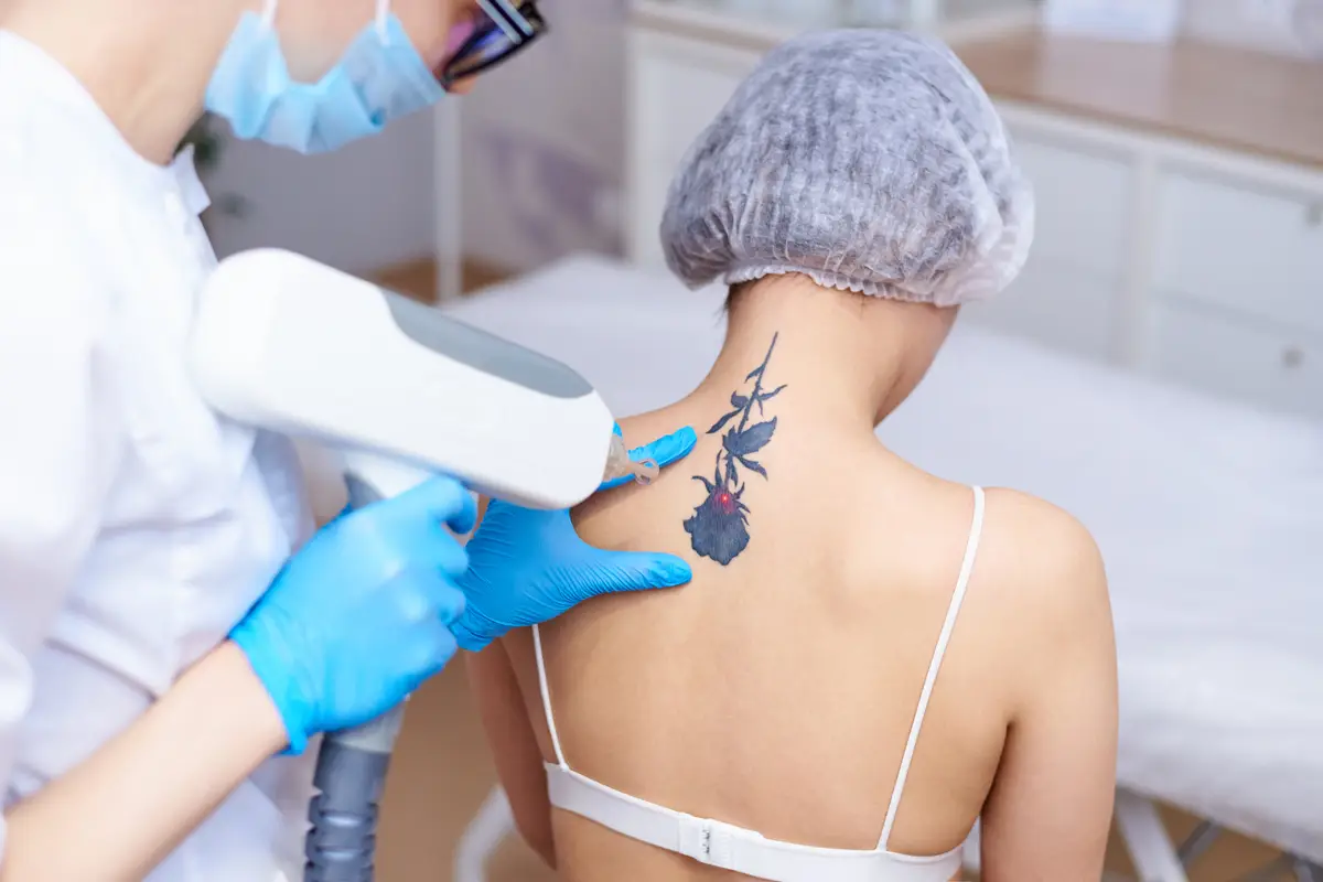 Remoção de Tatuagem e Micropigmentação